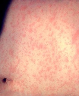 Closeup of a splotchy measles rash